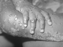 España eleva a 84 los casos confirmados de viruela del mono