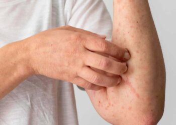 Viruela del mono: mitos, realidades y cuidados