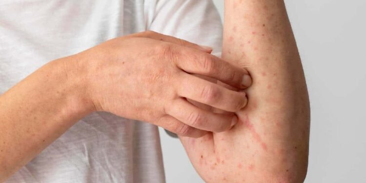 Viruela del mono: mitos, realidades y cuidados